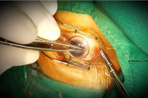 Hai người đàn ông sáng mắt nhờ được ghép giác mạc miễn phí