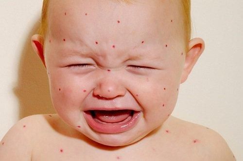 Em bé gặp nguy kịch chỉ vì nụ hôn