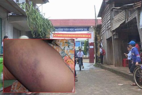 Cô giáo đánh học sinh lớp 3 bầm tím đùi bị phạt 3,75 triệu đồng