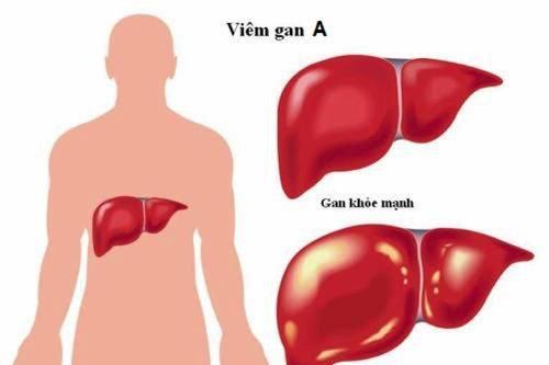 Nhận biết bệnh viêm gan A