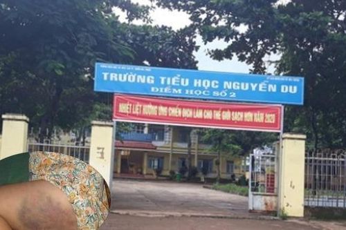 Đình chỉ dạy 3 tháng giáo viên đánh tím đùi nữ sinh