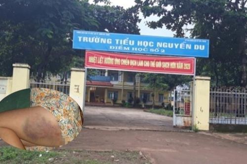 Xử phạt nữ giáo viên đánh bầm đùi học sinh hơn 3,7 triệu đồng, đình chỉ dạy 3 tháng