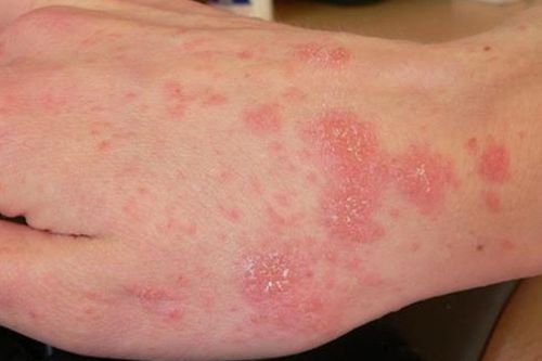 Cẩn trọng với các loại nấm da phổ biến vào mùa mưa