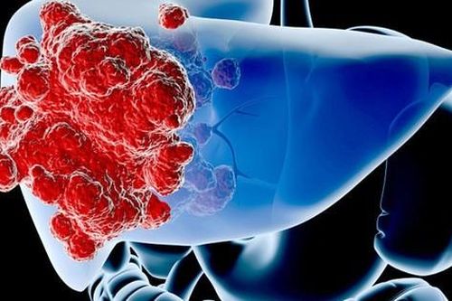 Căn bệnh nhiều người mắc mà không biết, ai ngờ có thể âm thầm tiến triển thành ung thư gan