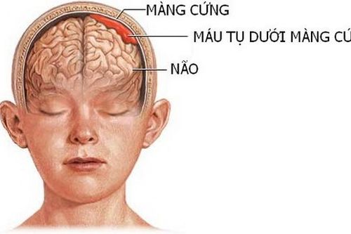 Máu tụ dưới màng cứng mạn tính ở người cao tuổi