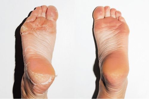 8 cách chữa nứt nẻ gót chân tại nhà