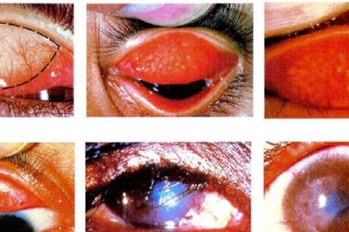 Phòng bệnh mắt cho người dân vùng lũ