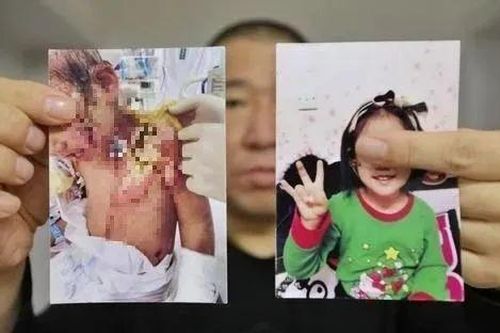 Sống cùng mẹ ruột và bạn trai của mẹ vài tháng, bé gái 6 tuổi bị bẻ răng, dội nước sôi
