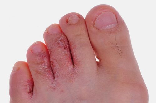 Điềm nhanh 6 cách phòng tránh bệnh nấm da vào mùa mưa