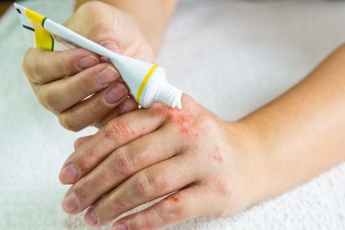 Một vài câu hỏi thường gặp về thuốc kháng nấm tại chỗ và tác dụng phụ của thuốc