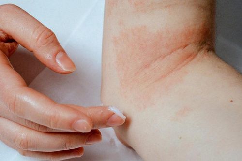 Điều trị nấm da đừng mắc phải những sai lầm này