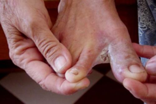 Bệnh da thường gặp sau mùa lũ và khuyến cáo cần biết