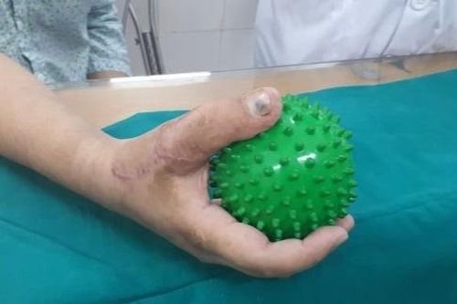 Nam thanh niên được ghép ngón chân thành ngón tay cái
