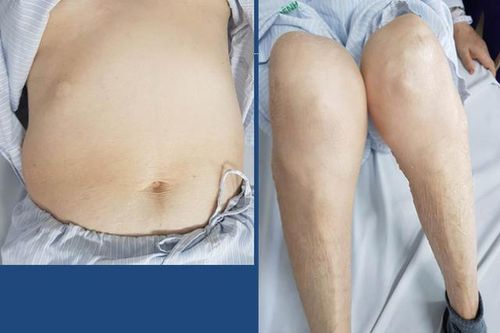 Teo cơ tứ chi vì lạm dụng thuốc chứa corticoid