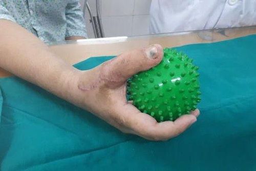 Phẫu thuật chuyển ngón chân thành ngón tay cho nam thanh niên 17 tuổi
