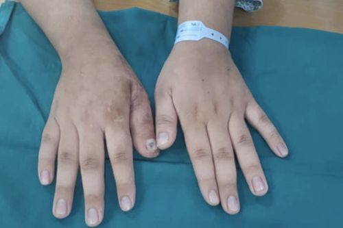 Lấy ngón chân làm ngón tay cho cậu bé 17 tuổi