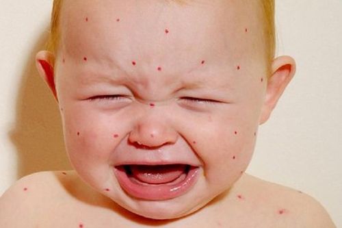 Vaccine sởi đơn và vaccine kết hợp sởi - quai bị - rubella: Nên chọn tiêm loại vaccine nào mới tốt?