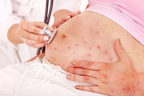Bệnh sởi ở phụ nữ mang thai: Làm sao để nhận biết và cách xử trí an toàn