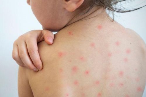 Một số biện pháp chăm sóc trẻ bị sởi tại nhà an toàn và hiệu quả