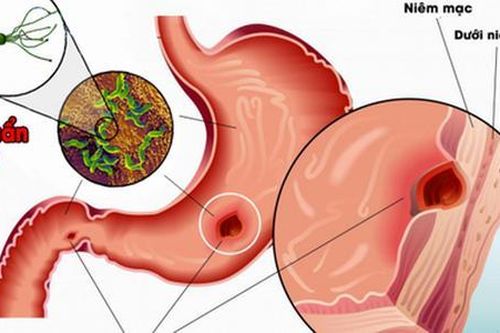 Hóa giải bệnh dạ dày, tăng chất lượng cuộc yêu