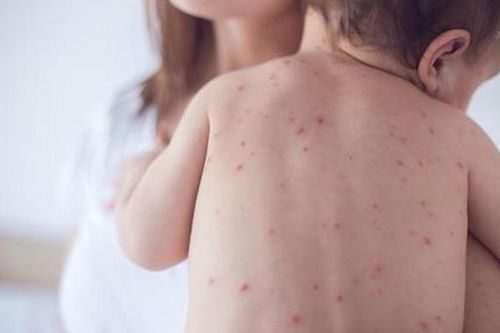Từ viêm phổi đến tử vong: Những biến chứng bệnh sởi ở trẻ nhỏ bạn cần biết