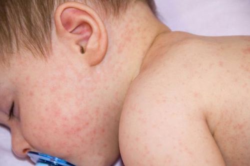 Khuyến cáo dự phòng lây nhiễm mới mùa dịch sởi