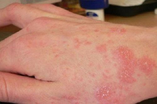 11 quan niệm sai lầm về bệnh nấm da không phải ai cũng biết