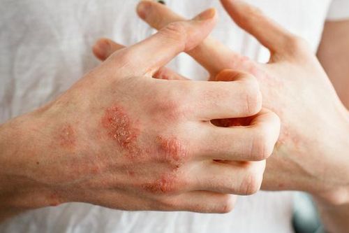 Những yếu tố nào làm tăng nguy cơ bị bệnh nấm da?