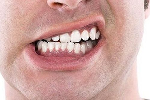 7 thói quen hủy hoại hàm răng mà nhiều người vẫn vô tư làm hằng ngày