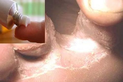 Nấm kẽ chân mùa mưa và thuốc trị