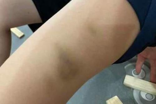 Phụ huynh tố cô giáo dùng thước đánh bầm tím chân, tay trẻ lớp 1