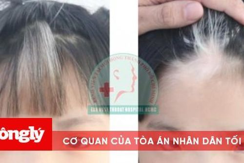 Bé gái bị tai điếc, mắt xanh bởi hội chứng hiếm gặp