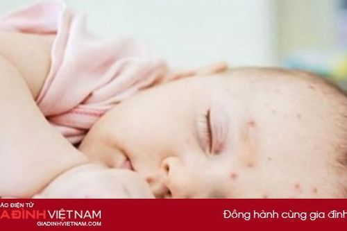 Cách chăm sóc trẻ bị bệnh sởi tại nhà tránh biến chứng nguy hiểm
