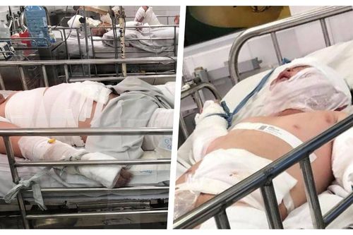 Thương tâm hai bệnh nhi bỏng nặng do cha ruột châm lửa đốt nhà