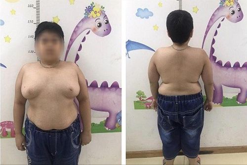 Báo động lạm dụng corticoid gây hậu quả nặng nề