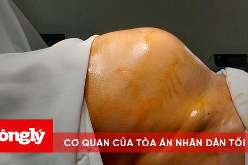 64 tuổi mới đi khám lần đầu, người phụ nữ phát hiện khối u 'khủng'