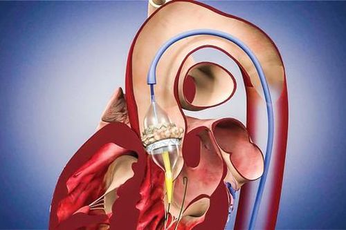 Kỹ thuật thay van tim động mạch chủ qua ống thông
