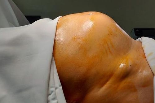 Bà 64 tuổi bụng to như mang thai 7 tháng, đi khám mới biết mang khối u ác tính