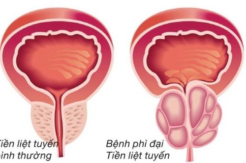 Quan hệ tình dục ở người bị phì đại tuyến tiền liệt
