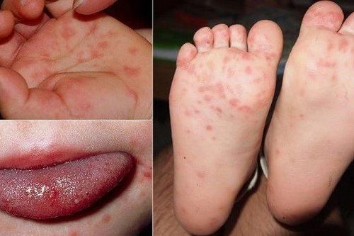 Hiểu đúng về chứng phát ban sau sốt ở trẻ