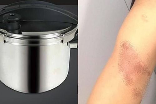 Đang nấu ăn thì nồi áp suất phát nổ: Một người mẹ bị bỏng nặng, em bé 2 tuổi thoát nạn