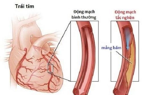 Bệnh mạch vành ở người cao tuổi