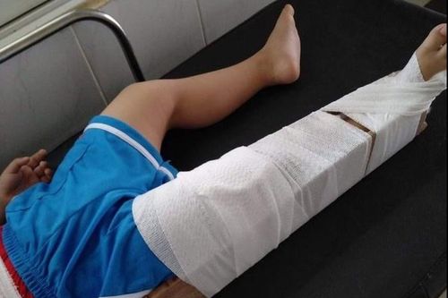 Cô giáo bị đình chỉ dạy học vì làm gãy chân trẻ 3 tuổi