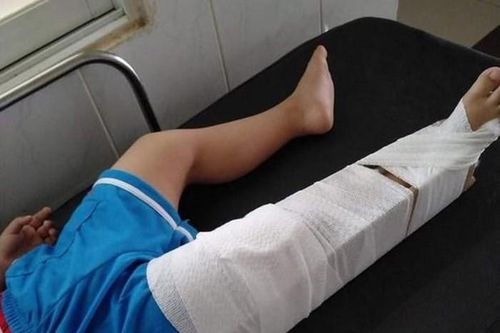Cô giáo ở Đồng Nai làm gãy chân trẻ mầm non 3 tuổi