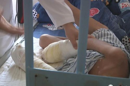 Bé trai 7 tuổi bị bố ruột bạo hành, 2 bàn tay bị hoại tử tới mức có thể phải cắt cụt