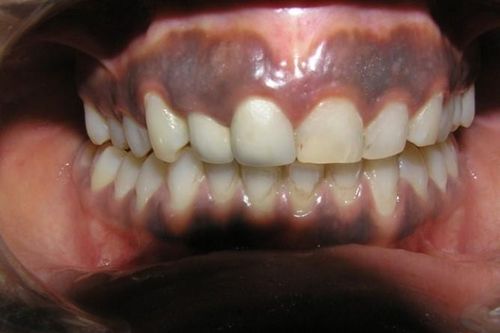 Dấu hiệu dễ nhận biết trẻ nhiễm độc chì