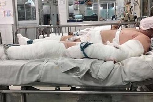 BV Nhi đồng 1 tiếp nhận hai bé bỏng nặng do tai nạn cháy nhà
