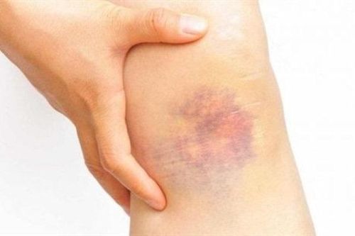 10 nguyên nhân làm bầm tím da