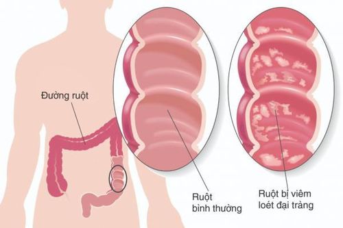 Viêm đại tràng mạn tính: triệu chứng, nguyên nhân, phòng và điều trị bệnh