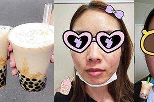 Nghiện trà sữa, hai cô gái nổi mụn chi chít như tổ đỉa trên mặt